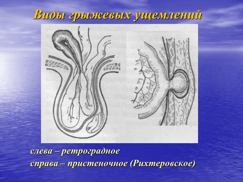 Виды грыжевых ущемлений слева – ретроградное справа – пристеночное (Рихтеровское)